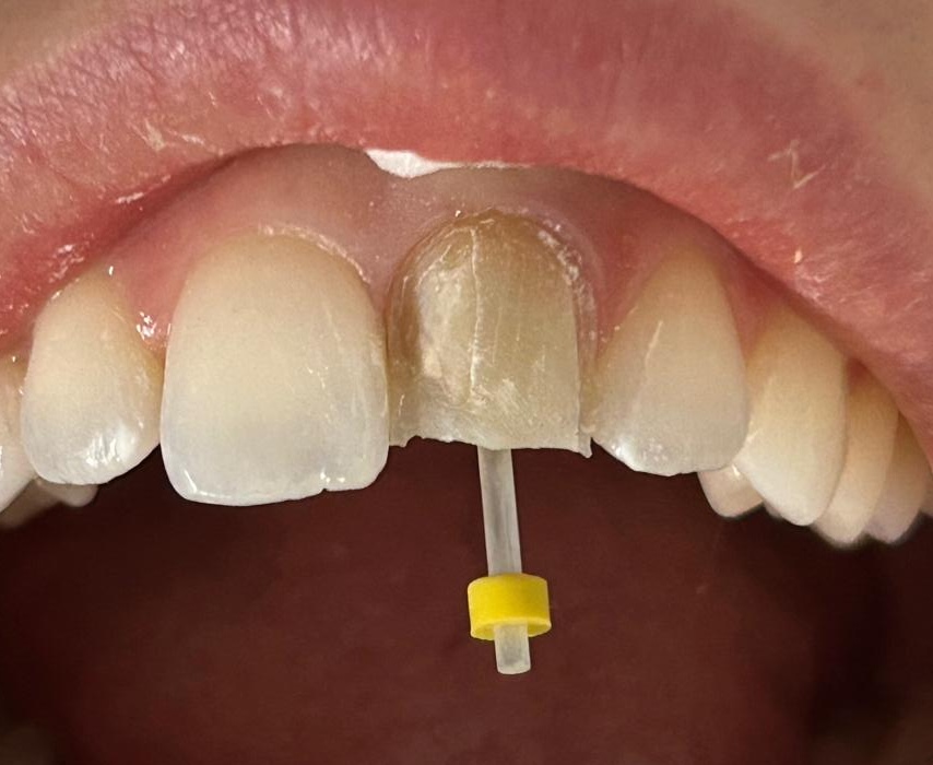 Diş Destekleri