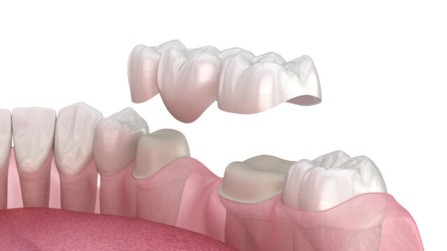 Diş Eti Hastalığı