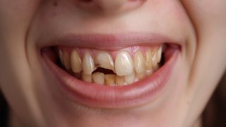Diş Erozyonu Nedir? 1