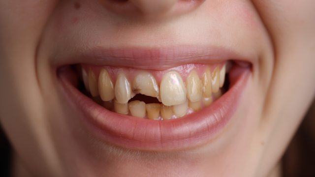 Diş Erozyonu Nedir? 5