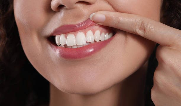 Diş Eti Çekilmesi Sorununa Ne İyi Gelir? 9 gum recession