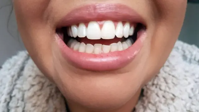 Формирование зубов