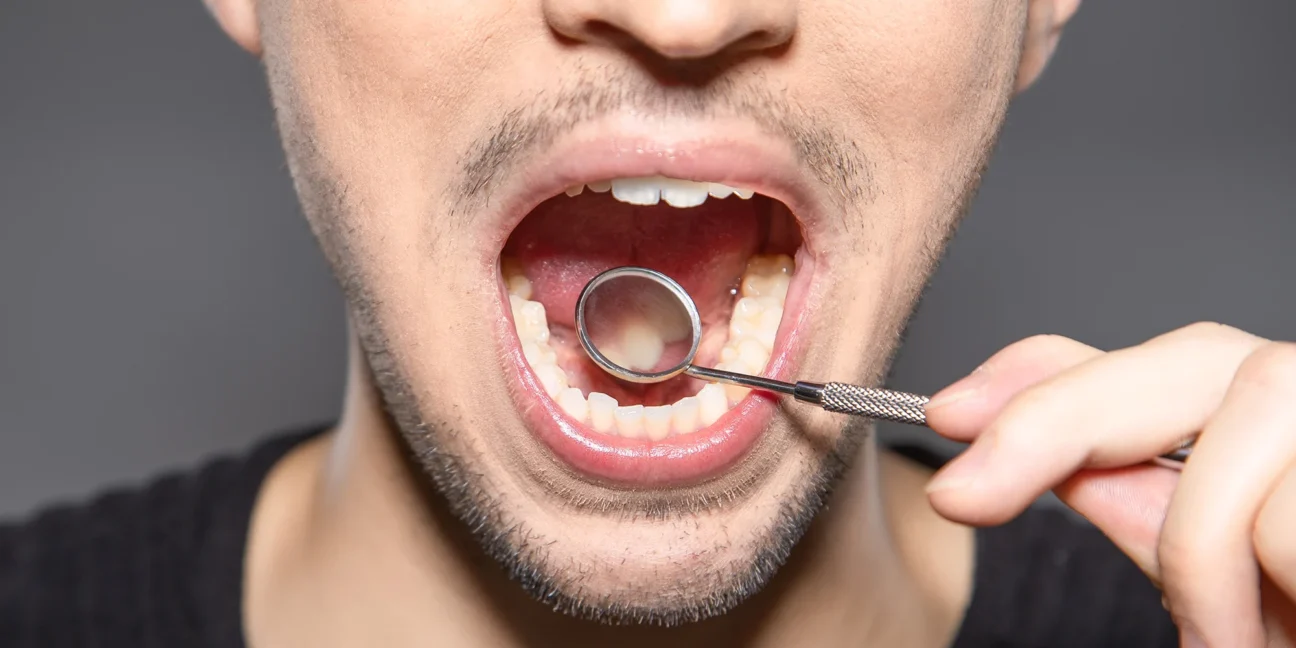 What Causes Dry Mouth? Understanding the Science Behind Saliva Deficiency | Livera Dental Clinic