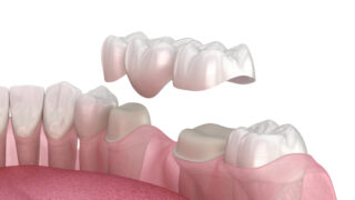 Зубной мост