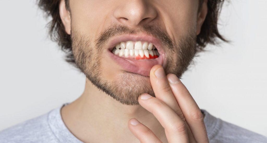 effective solutions for bleeding gums