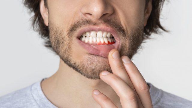 effective solutions for bleeding gums