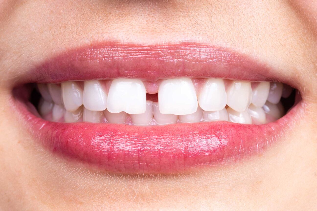 What is Gap Tooth Treatment and How is it Performed? | Livera Dental Clinic Istanbul