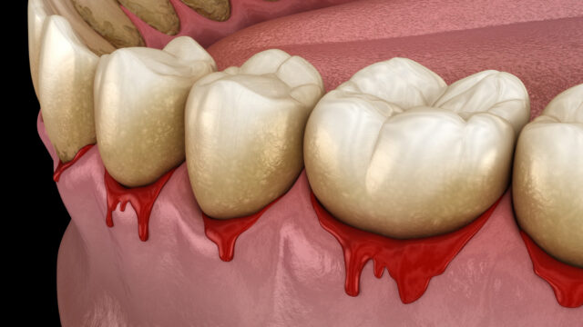 What Causes Gum Disease? | Livera Dental Clinic