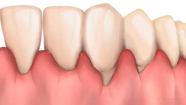 Gum Inflammation: Symptoms & Treatments | Livera Dental Clinic