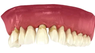 Diş Taşı Temizleme