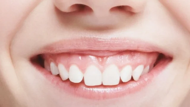 Invisalign