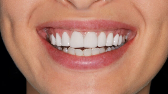 Diş Eti Hastalığı