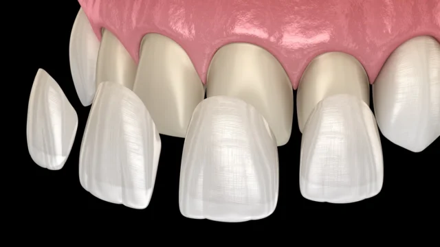 How Are Dental Veneers Made? | Livera Dental Clinic