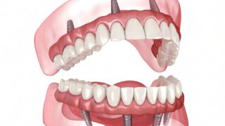 What Are the Stages of Healing in Dental Implants? | Livera Dental Clinic