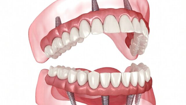 What Are the Stages of Healing in Dental Implants? | Livera Dental Clinic