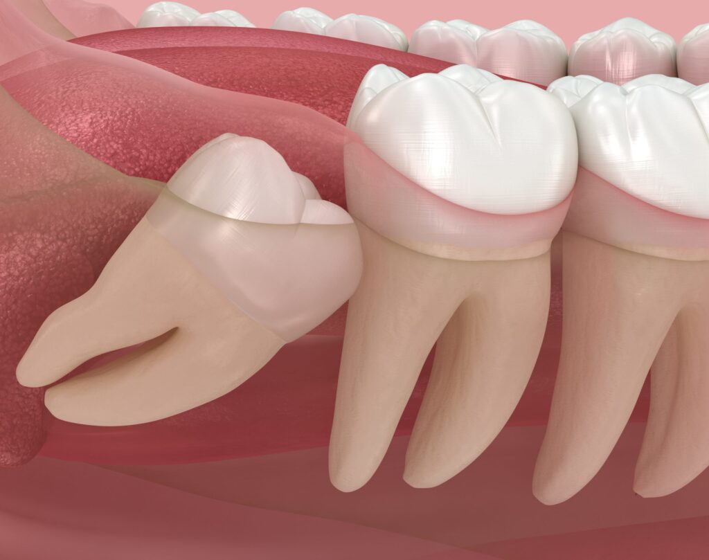 impacted tooth