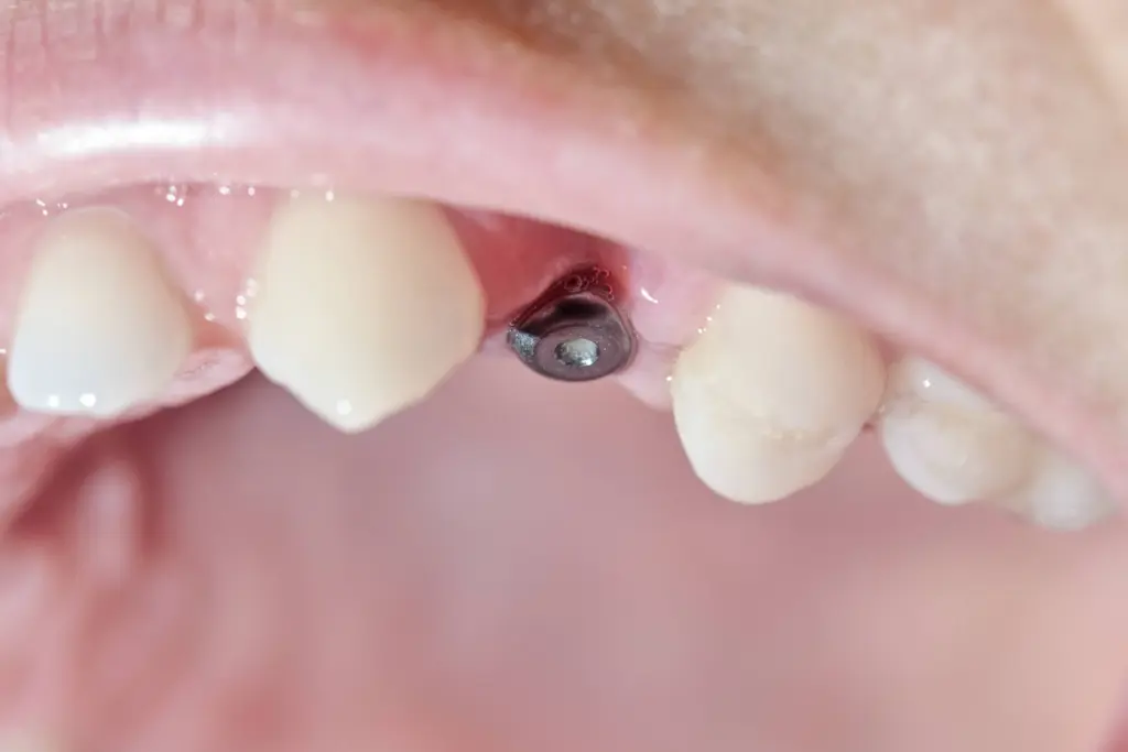 implant tedavisi sonrası