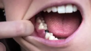 implant tedavisi sonrası