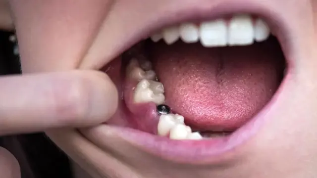 implant tedavisi sonrası