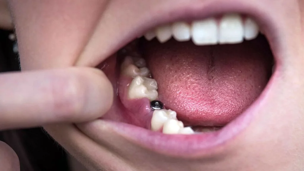 implant tedavisi sonrası