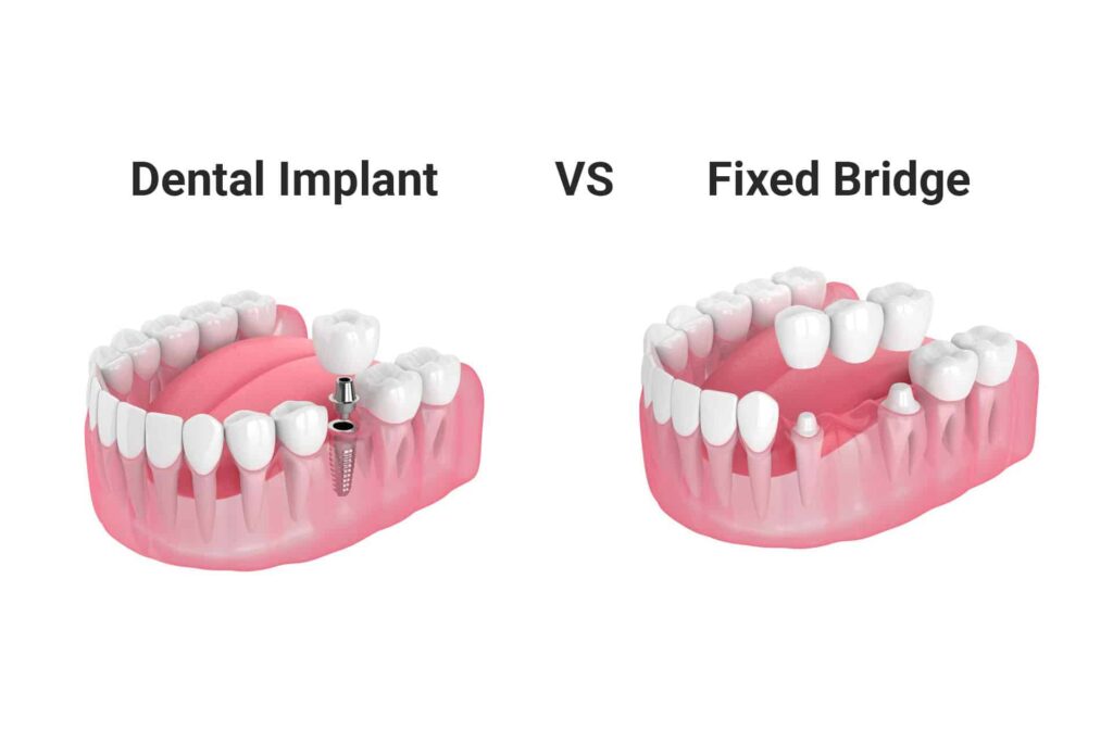 Implant vs. Prosthesis