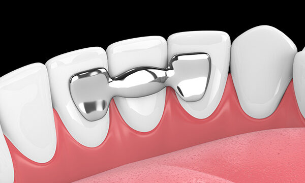 What is the Maryland Bridge? Advantages and Disadvantages | Livera Dental Clinic Istanbul