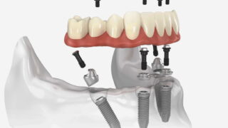 Зубной мост