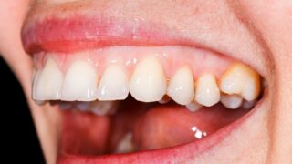 Diş rekonstrüksiyonu