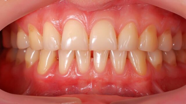 Diş Eti Çekilmesinin Dikkate Alınması Gereken 5 Aşaması | Livera Dental Clinic