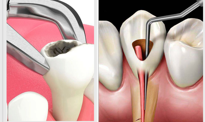 Root Canal Treatment or Tooth Extraction