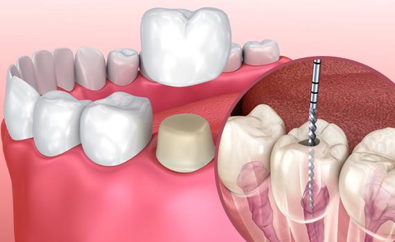 Root Canal Treatment or Tooth Extraction