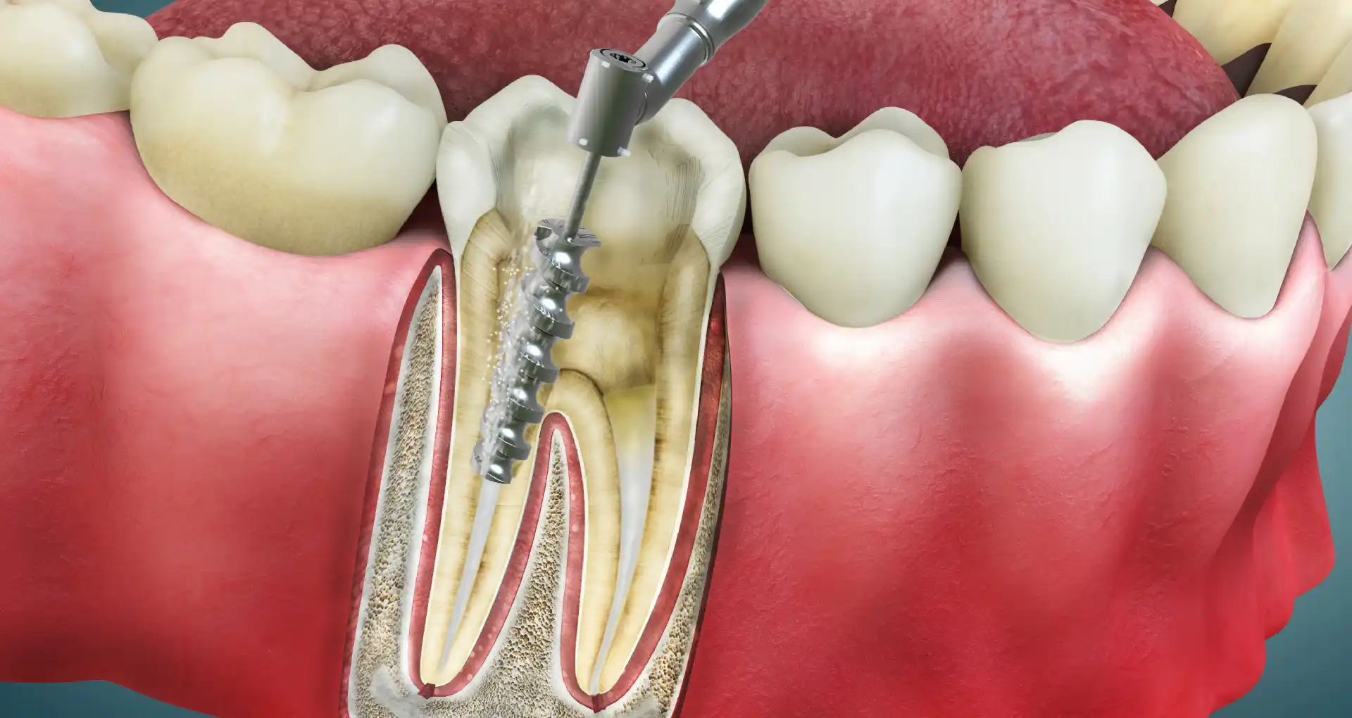 Root Canal Treatment