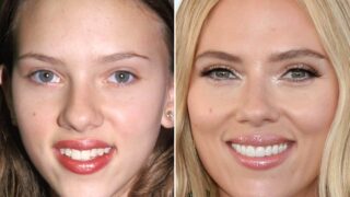 Laminalar vs. Kronlar