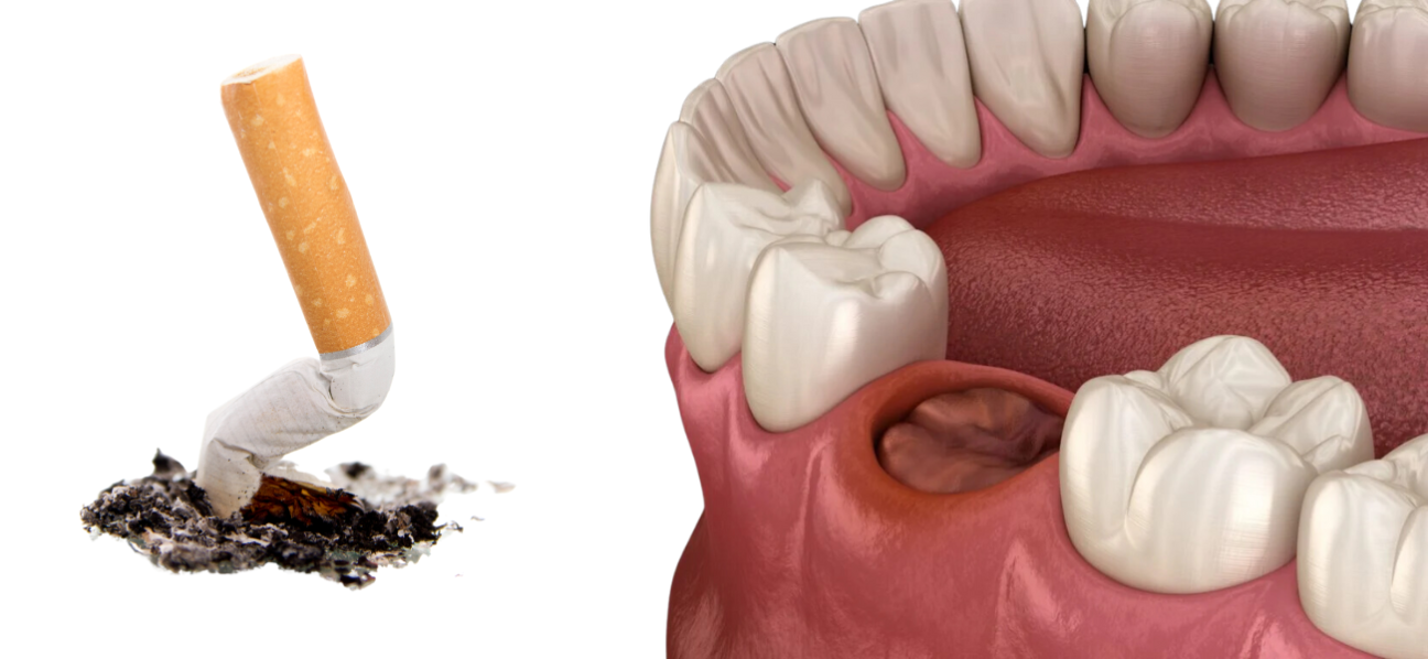 Is It Okay to Smoke After a Tooth Extraction? | Livera Dental Clinic