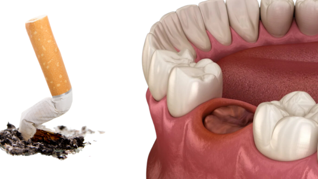 Is It Okay to Smoke After a Tooth Extraction? | Livera Dental Clinic