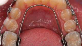dental implant