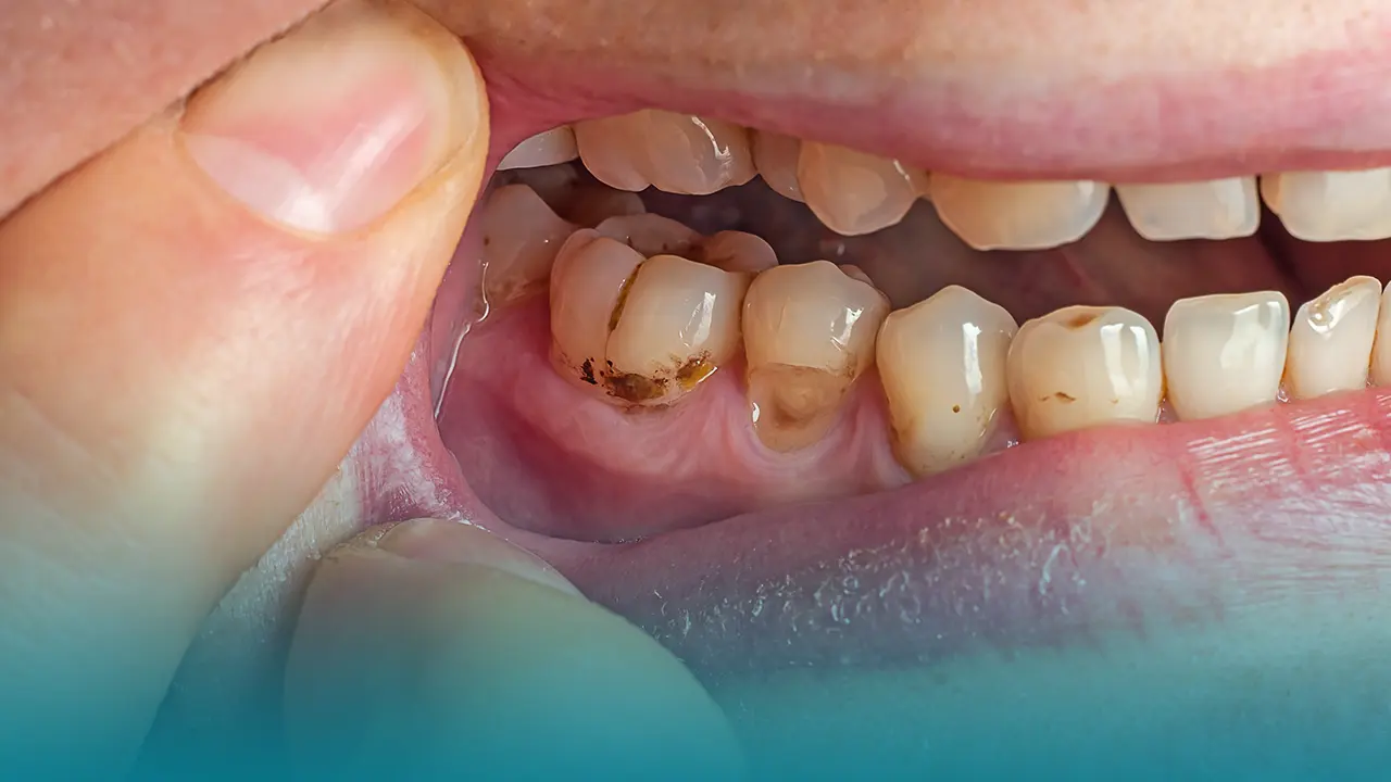 Diş Taşı Temizleme