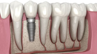Dental Implants in Turkey Guide: Livera Clinic Perspective | Livera Dental Clinic Istanbul