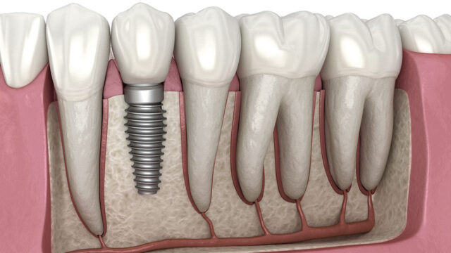 Dental Implants in Turkey Guide: Livera Clinic Perspective | Livera Dental Clinic Istanbul
