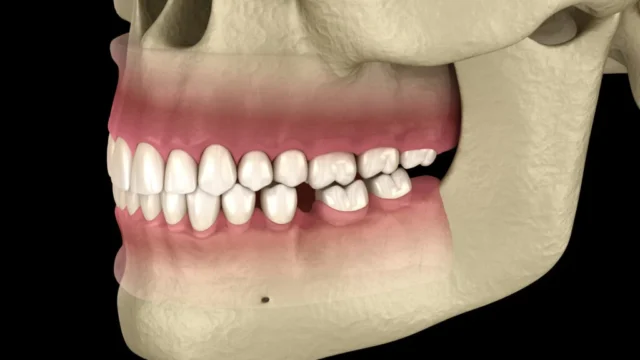 Straumann İmplantları