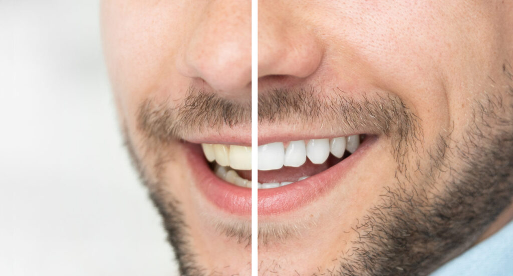 Teeth Whitening or Teeth Cleaning? Understanding the Real Difference for a Brighter, Healthier Smile | Livera Dental Clini...