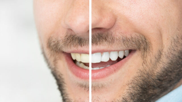 Teeth Whitening or Teeth Cleaning? Understanding the Real Difference for a Brighter, Healthier Smile | Livera Dental Clini...