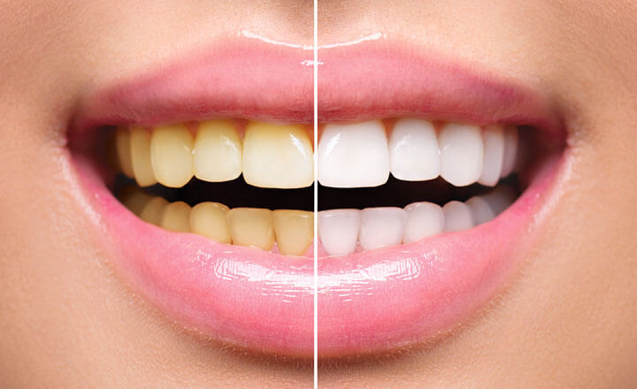 teeth whitening