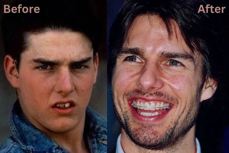 Tom Cruise Dişleri