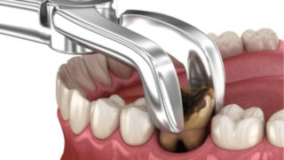 Tooth Extraction