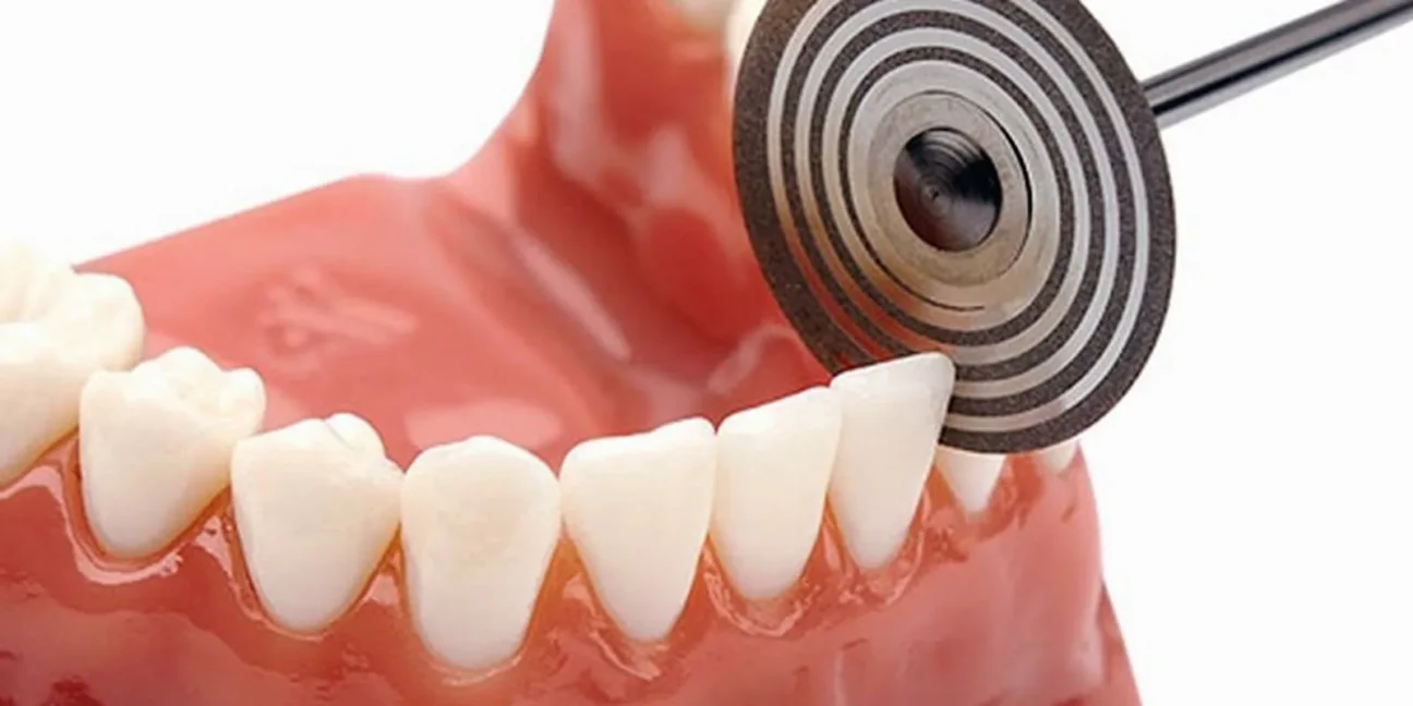 What is Tooth Contouring and Who Might Need This Procedure? | Livera Dental Clinic