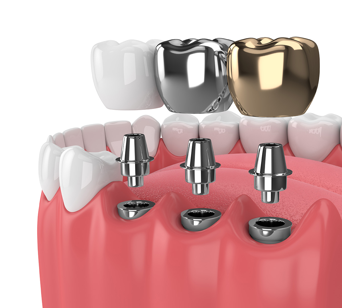Different Types of Dental Implants: Their Advantages and Disadvantages | Livera Dental Clinic