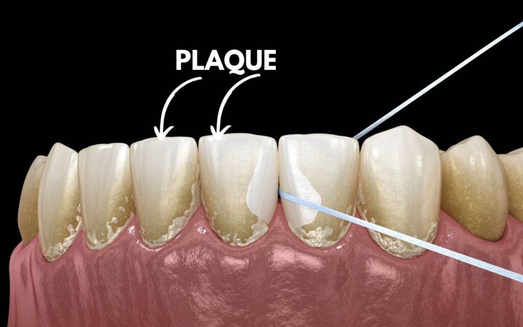 Dental Plaque