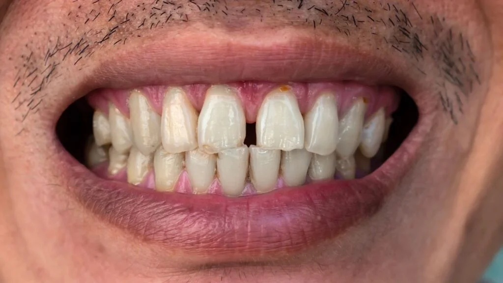 Diastema