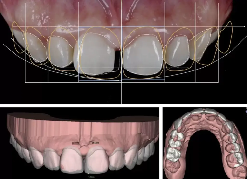 What is Digital Smile Design? A Comprehensive Overview 2 Digital Smile Design
